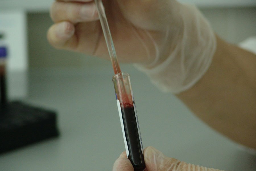 Scienziati milanesi inventano un “naso” elettronico che fiuta il tumore