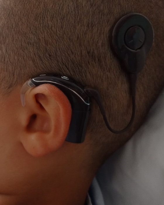 In Sardegna primo impianto di orecchio “bionico” su bimbo non udente