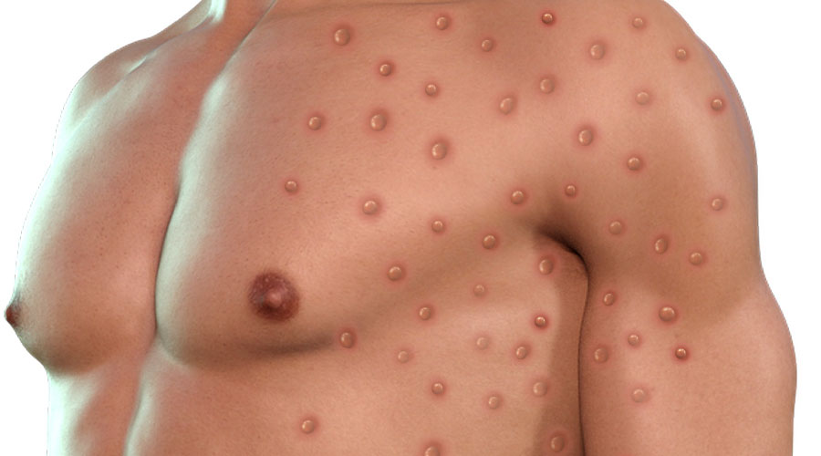 Vaiolo scimmie. Salgono ancora i casi in Italia: in Sardegna sono cinque